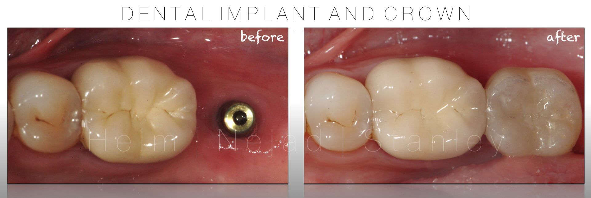 dental implant before and after