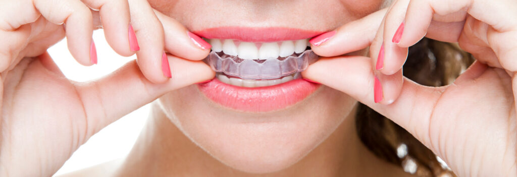 Straighter Teeth with Invisalign Clear Aligners | Beverly Hills, CA