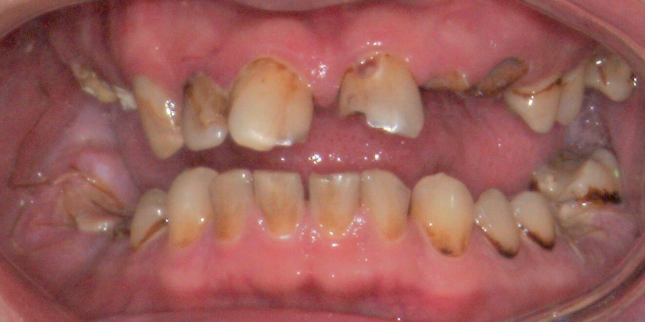 Drug Helps Teeth Repair Themselves