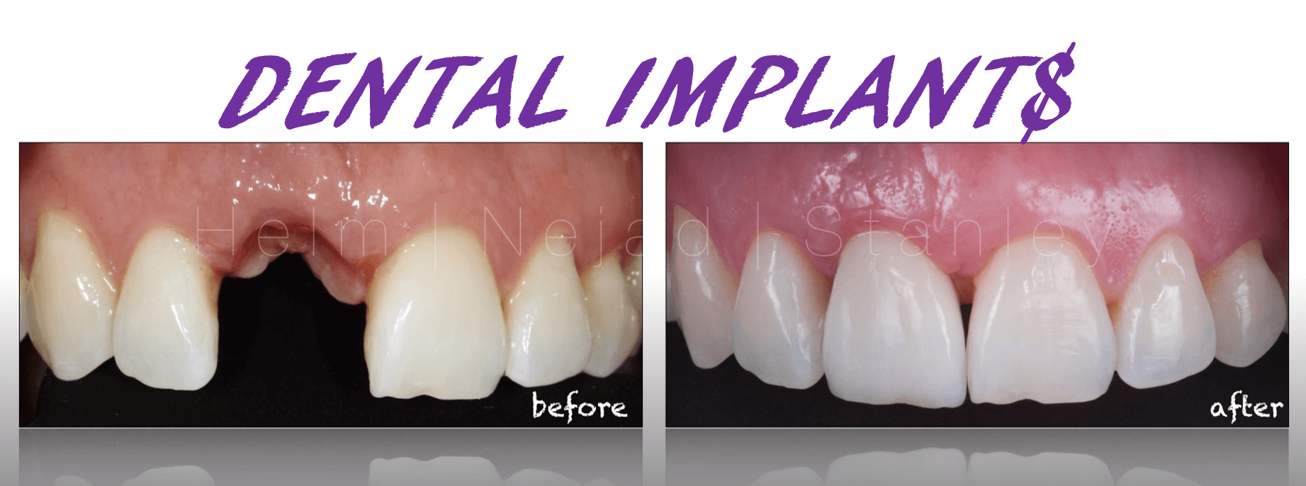 How Much Are Dental Implants Dental Implant Price Factors