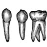 history of dental implants