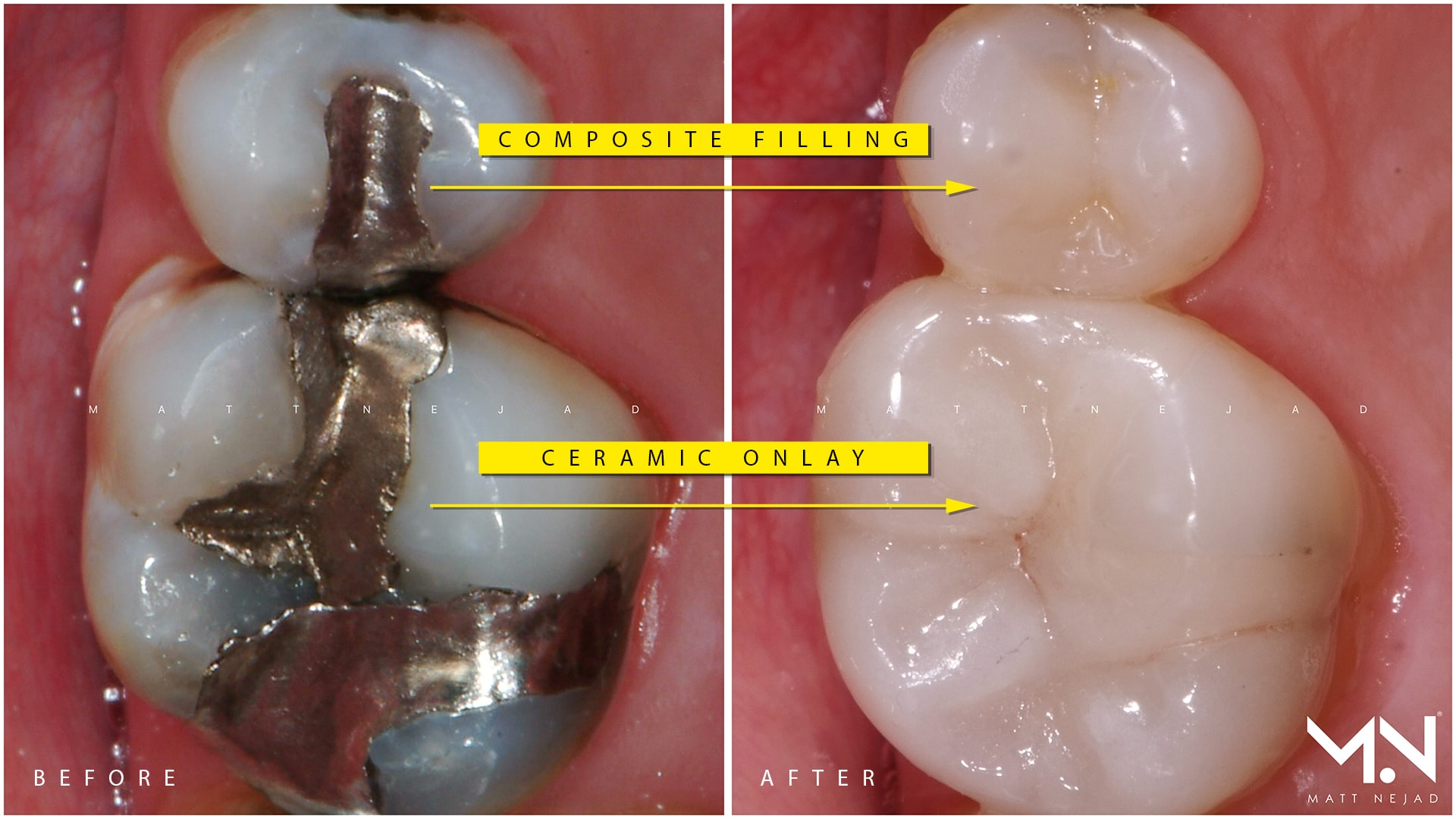 how do silver fillings work