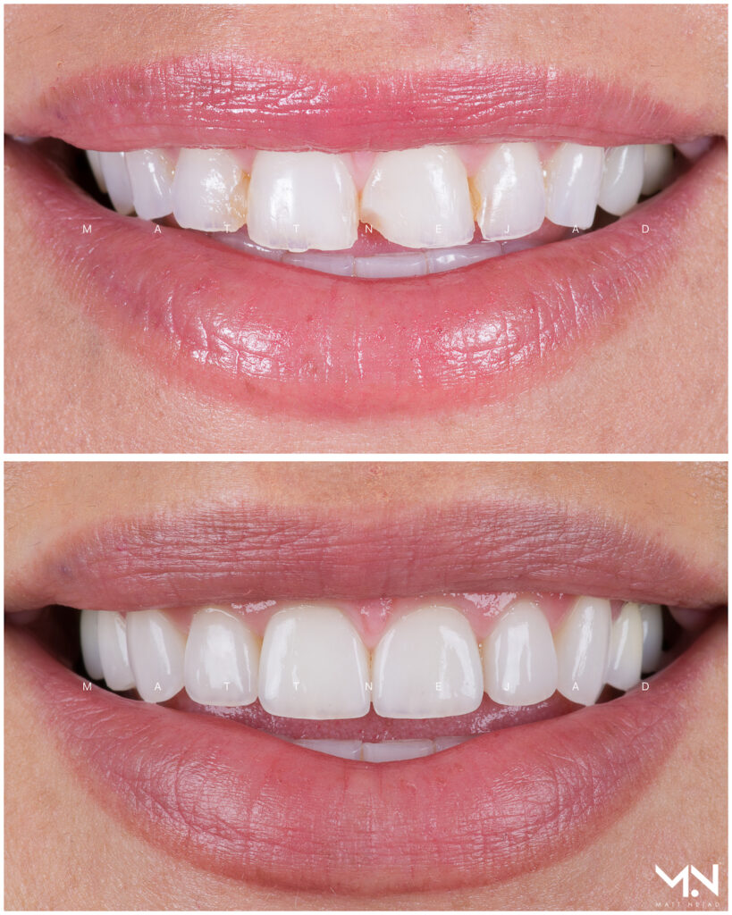 Cosmetic Dentistry Before and After Photos | Helm Nejad Stanley