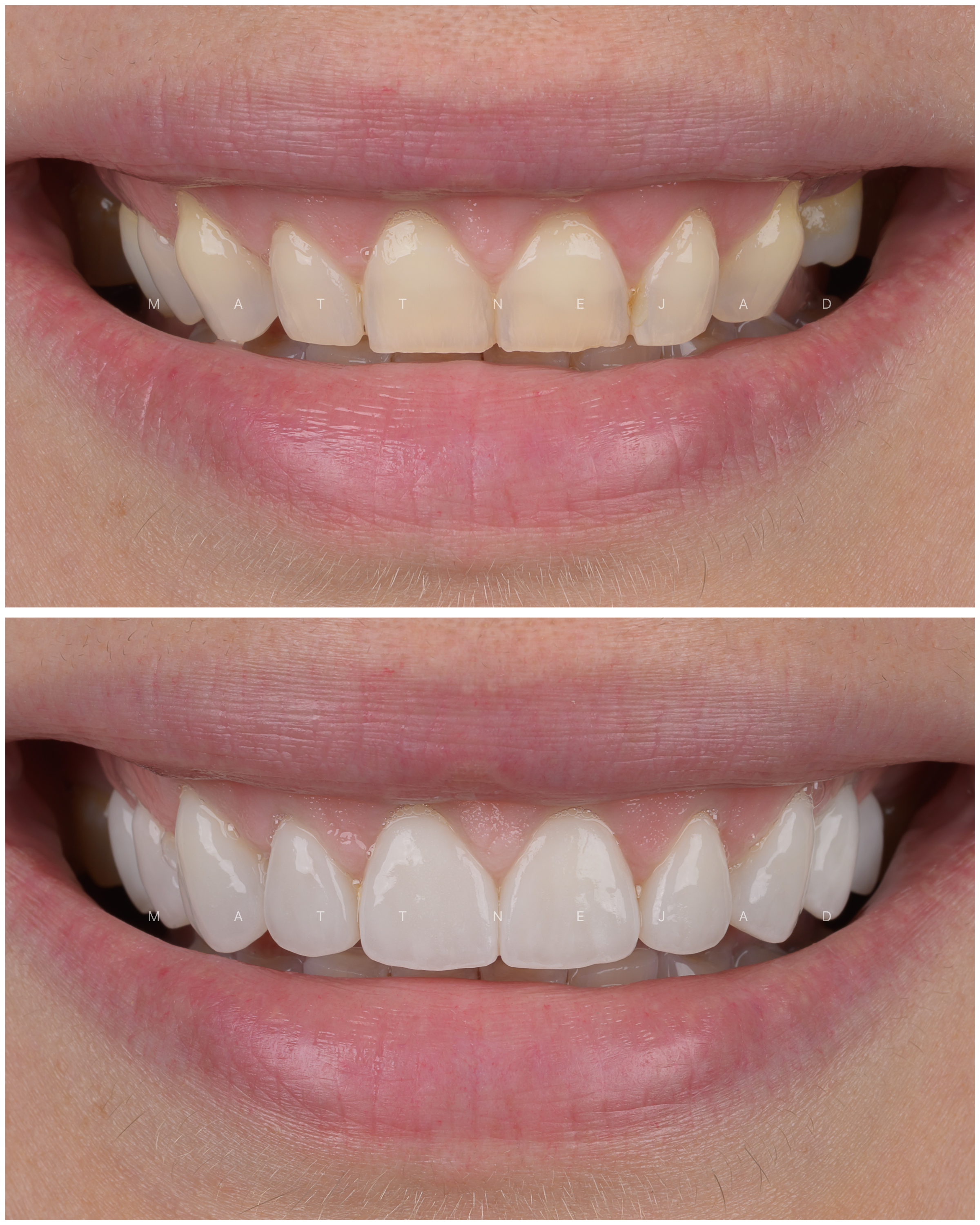 Case #28 - Before & after of 10 veneers