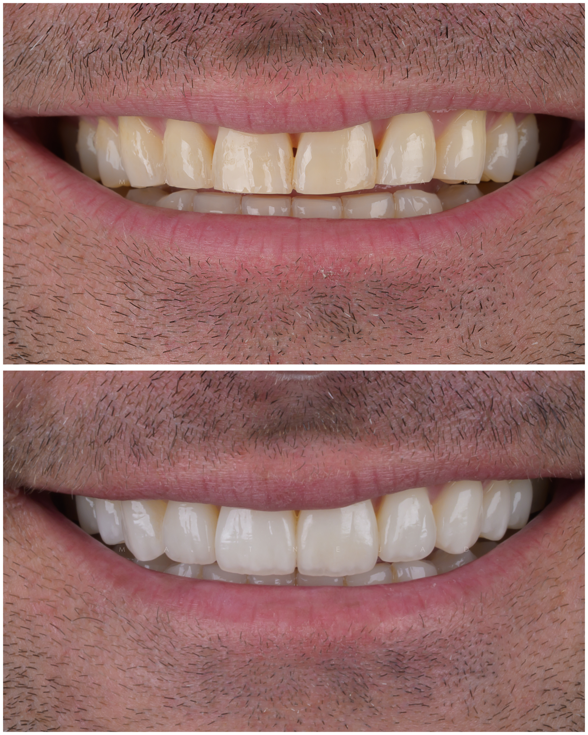 Closeup before & after Case #29 - 10 Veneers